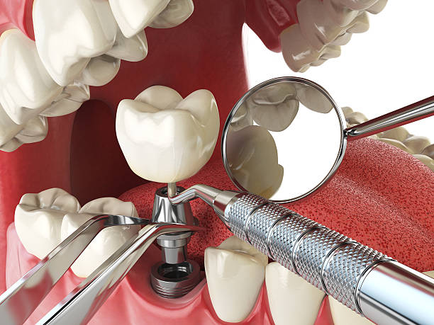 Best Emergency Wisdom Tooth Extraction in Wake Village, TX
